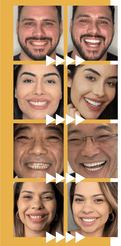 Featured image for “What Are Dental Veneers? Before & After Look”