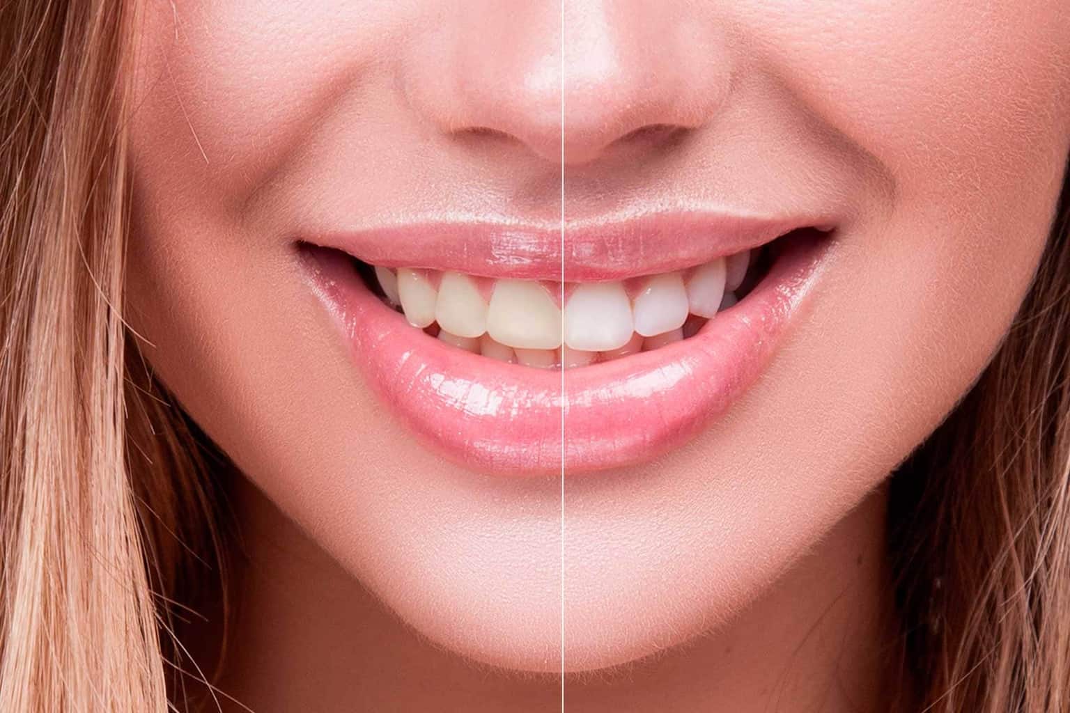 Featured image for “Unbeatable Teeth Whitening Promotion at VIP Dental”