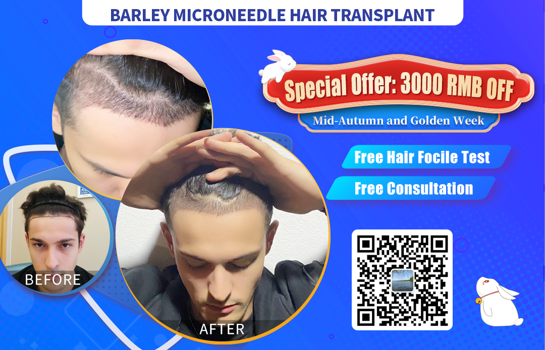 Featured image for “Special Offer 3000 RMB Off Hair Transplant: Chinese National Holidays”